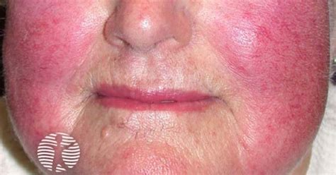 dermnet|dermnet rosacea.